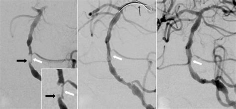 Digital Subtraction Angiography Dsa Showed Basilar Artery Ba Download Scientific Diagram