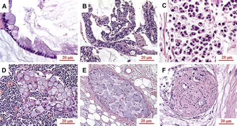 Histopathological Features Of Pseudomyxoma Peritonei He ×400 A Download Scientific Diagram