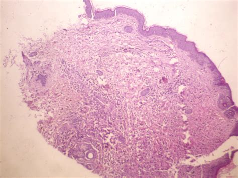 Langerhans Cell Histiocytosis Histology