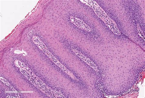 Verrucous Carcinoma Cervix