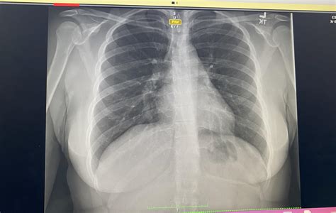 Anyway to tell if my rib is fractured : r/xrays