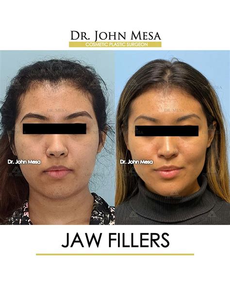 Jaw Filler Before & After Photos | Dr. Mesa