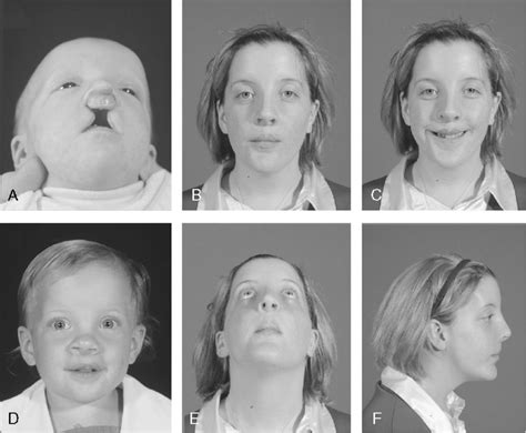 Completed Patient 7 A Preoperative Bilateral Complete Cleft Lip Nose Download Scientific