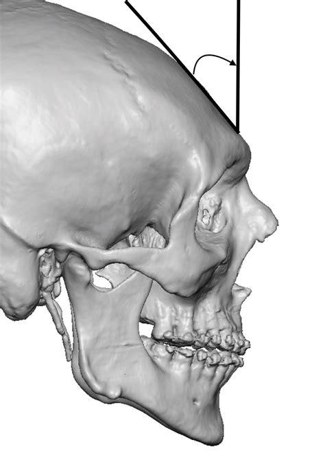 male sloped forehead amngle 3D CT scan Dr Barry Eppley copy - Explore ...