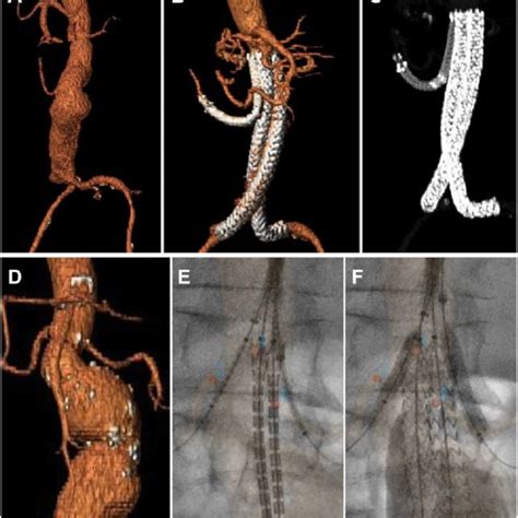 A Three Dimensional Computed Tomography 3D CT Reconstruction Of An