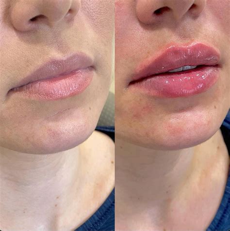 Preenchimento Labial Em Porto Alegre Duality Clinic