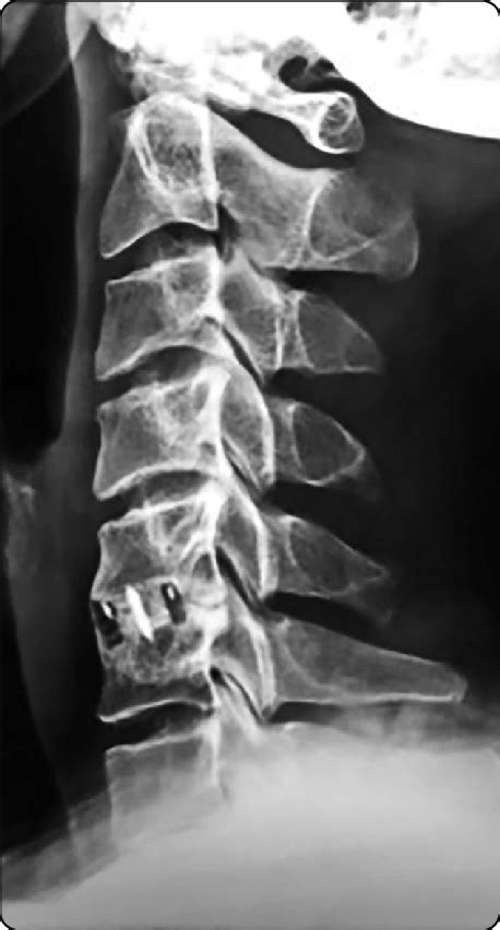 Postoperative X Ray Lateral View Of A Patient Who Had C5 6 Stand Alone Download Scientific