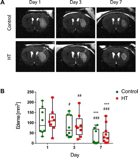 Longitudinal Monitoring Of The Edema Volume Using T2w Mr Imaging After