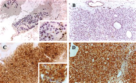 Galectin 3 Immunolocalization In Follicular Thyroid Adenoma A And C