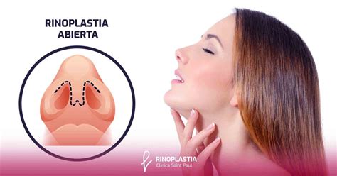 Rinoplastia Abierta Y Cerrada Ventajas Y Desventajas Rinoplastia Per