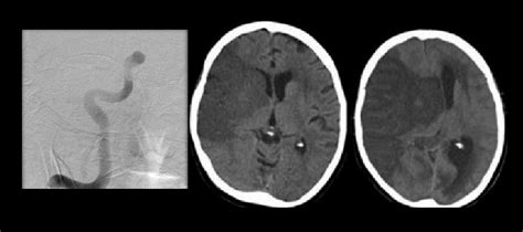 Clinical Characteristics Can Be Used to Predict Malignant MCA ...