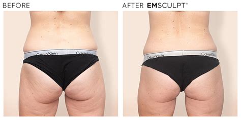 EmSculpt Non Invasive Butt Lift SILK Laser Clinics