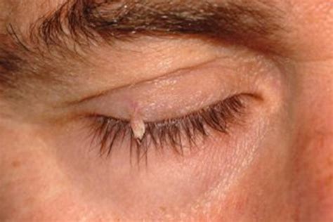 Minor And Benign Eyelid Lesions Neil Modi