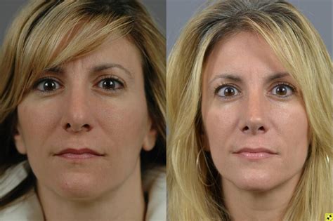 Nose Surgery Before After Long Island Dr Marotta