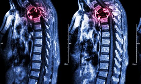 Prognostic Effect Of Bone Metastases In Medullary Thyroid Cancer