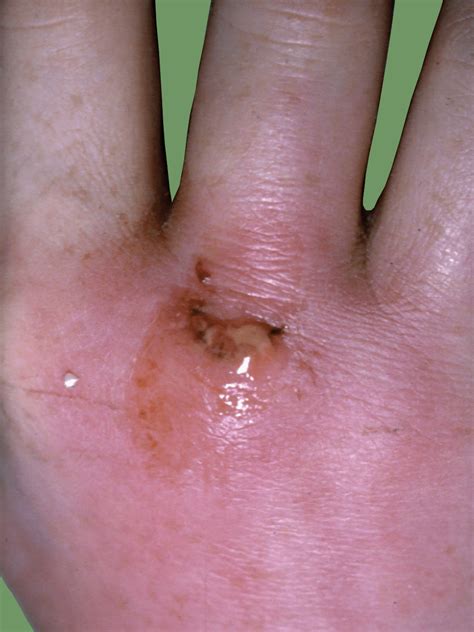 Septic Arthritis Infection Of A Joint Fife Virtual Hand Clinic