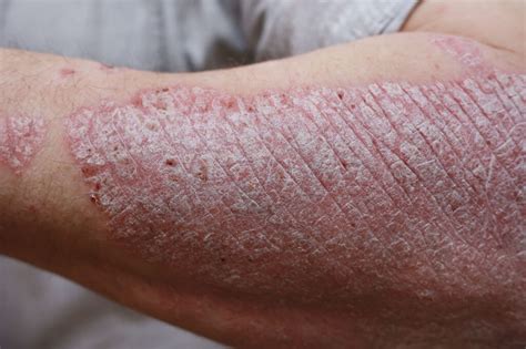 Psoriasis Treatment In Houston Houston Laser Skin Center