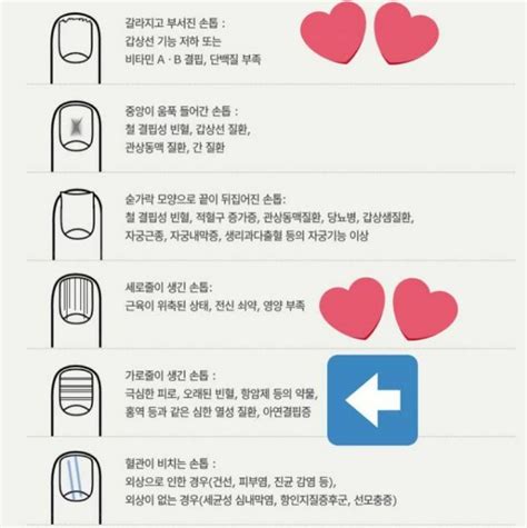 손톱으로 보는 건강상태 오픈이슈갤러리 인벤