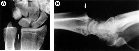 Distal Radial Ulnar Joint Druj Injuries Trauma Orthobullets