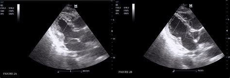 Visual Estimation Of Bedside Echocardiographic Ejection Fraction By