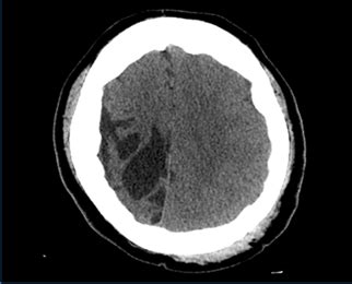 Porencephalic cyst due to encephalomacia with neuropsychiatric symptoms ...