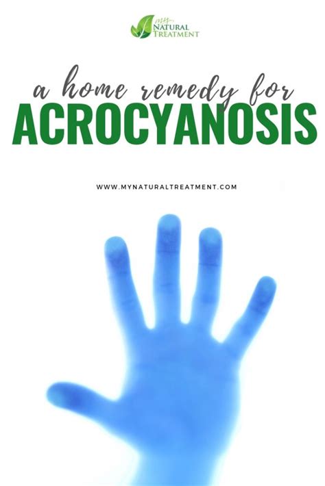 Complete Home Remedy for Acrocyanosis with 1 Simple Herb