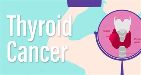 Thyroid Cancer: A Visual Guide