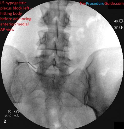 Fluoroscopic Guided Sacroiliac Sij Joint Dorsal Ramus And Lateral