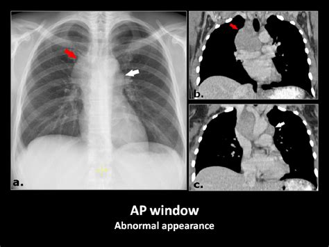 Figure 2 From Mediastinal Lines Stripes And Interfaces On Pa Chest Radiograph With Ct