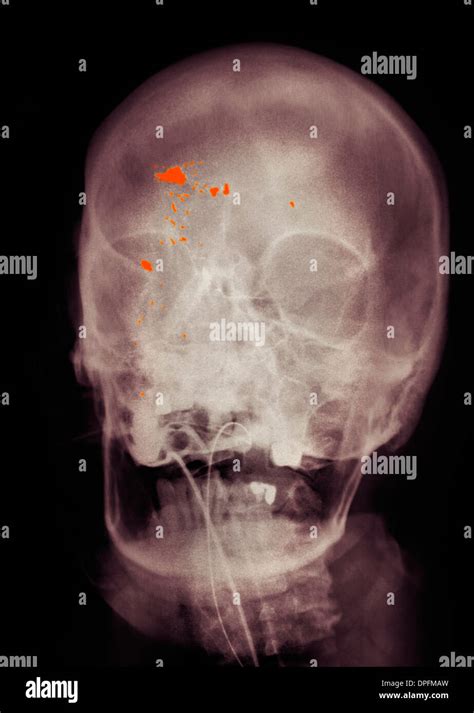 Gunshot Wound Graphic Hi Res Stock Photography And Images Alamy