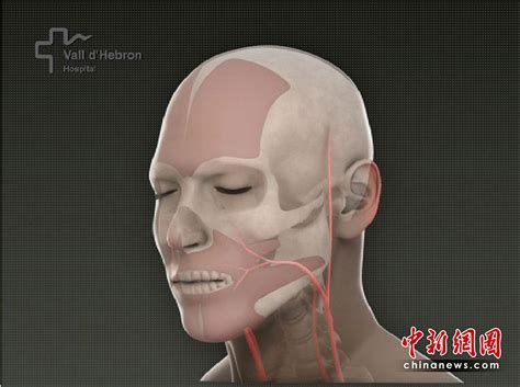 组图：世界首例完整面部移植手术成功 搜狐新闻