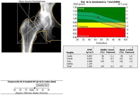 Densitometría ósea Clínica Ginecológica Abehsera