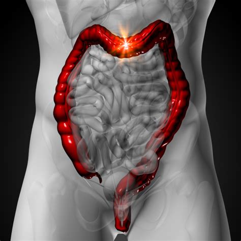 A Potential Source of Your Abdominal Pain: Diverticulitis | University ...