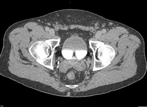 Parapelvic Cysts Left Kidney Kidney Case Studies Ctisus Ct Scanning