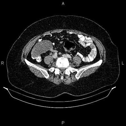 Appendiceal Mucocele Radiology Reference Article Radiopaedia Org