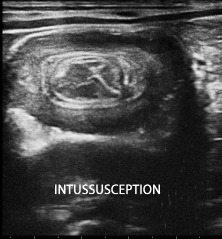 Intussusception Image Radiopaedia Org