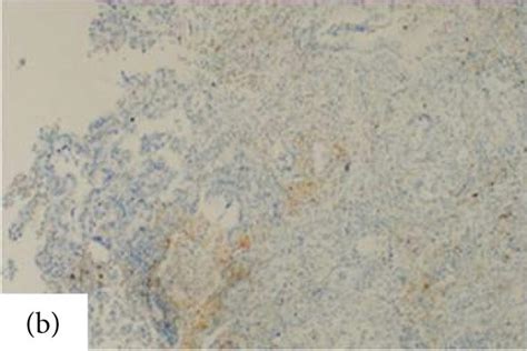 Pdl Staining In Primary Tumor And Metastatic Lymph Node In Gastric