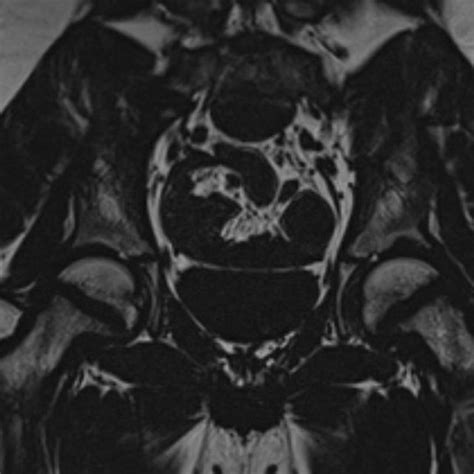 Magnetic Resonance Imaging Mri Of The Hips Showing Bilateral Slipped