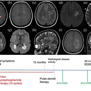 Pdf Cyclophosphamide In Highly Aggressive Marburg Like Multiple Sclerosis