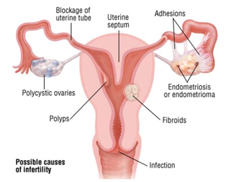 Genitourinary Obstetric Complications Flashcards Quizlet