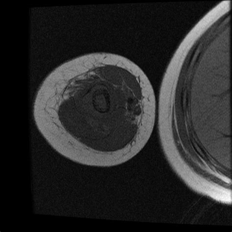 Osteosarcoma Image Radiopaedia Org