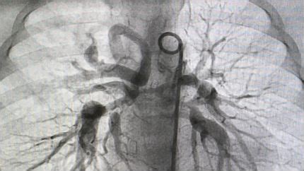 Aortography and Ventriculography – CardioVillage