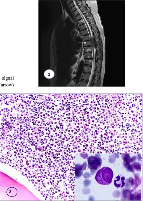 Figure 1 From Promyelocytic Sarcoma Presenting With Spinal Cord