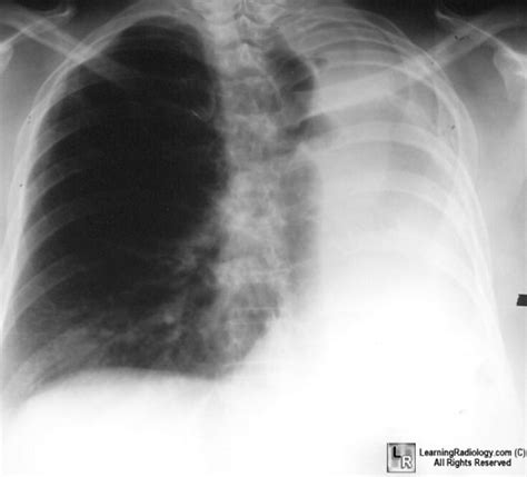 Pneumonectomy; Lung Volume Reduction