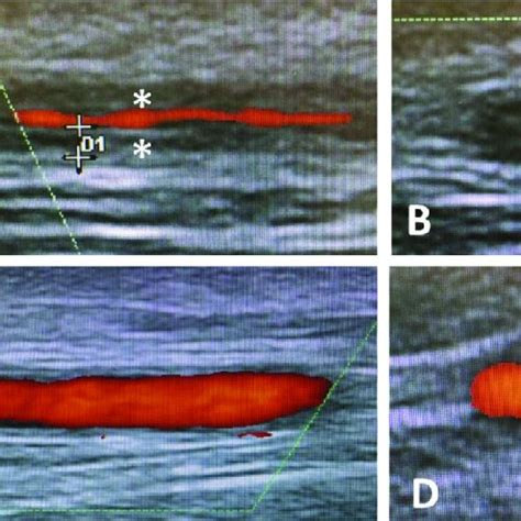 Temporal Artery Ultrasound The Non Compressible Hypoechoic Halo