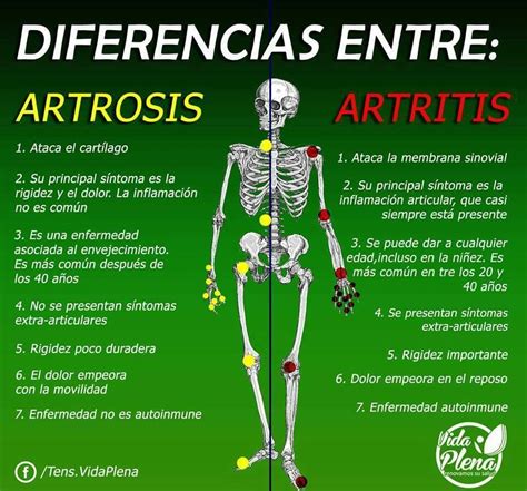 Cual Es La Diferencia Entre Artritis Y Artrosis Esta Diferencia Porn Sex Picture