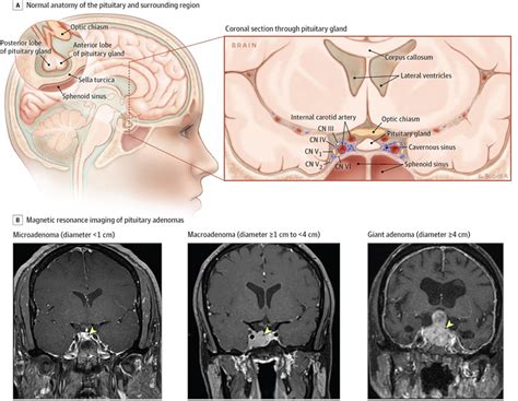 Diagnosis And Treatment Of Pituitary Adenomas A Review Endocrinology