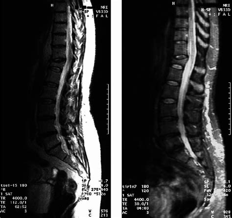 A T 2 Weighted And B Short Tau Inversion Recovery Stir Images