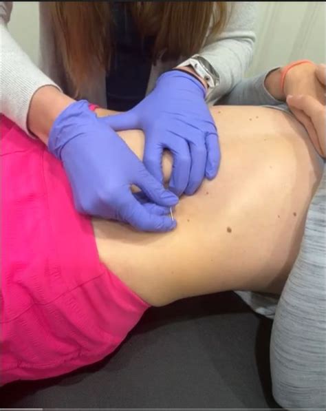 Dry Needling What Is It The Benefits Of Dry Needling For Moms