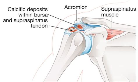 What Is A Barbotage Procedure For Calcific Rotator Cuff Tendinitis